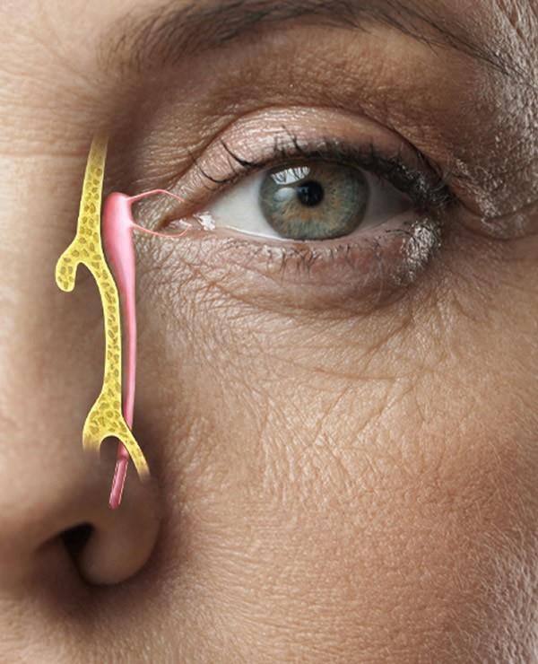 Göz Yaşı kanal Tıkanıklığı Nedir, Nedenleri Nelerdir?