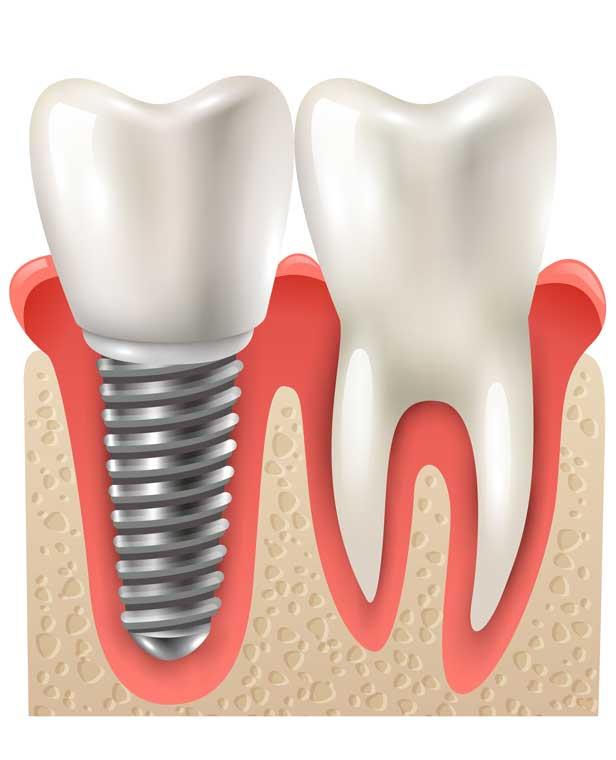 İmplant Yaptırmak için 7 Neden