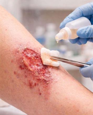 Açık Yara Tedavisi