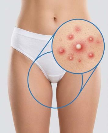 Genital Bölgede Sivilce