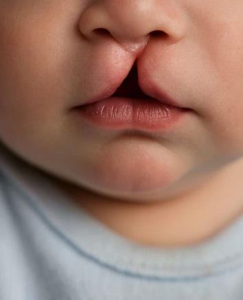 Tavşan Dudak (Yarık Dudak)