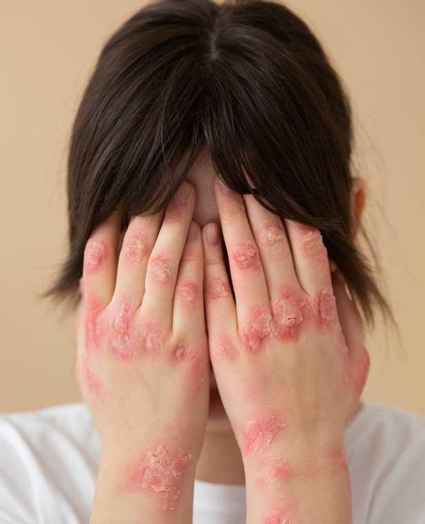 Sedef Hastalığı (Psoriasis)