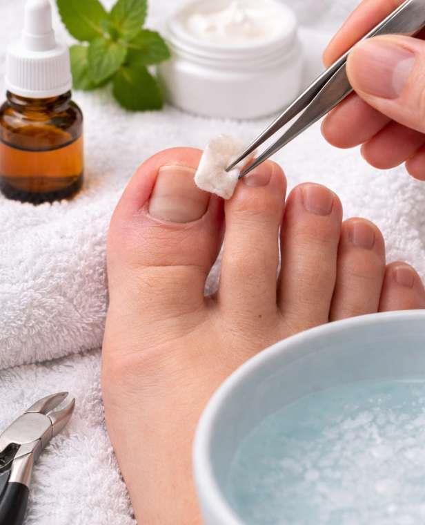 Tırnak Batmasına Ne İyi Gelir?